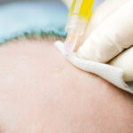 mesoterapia